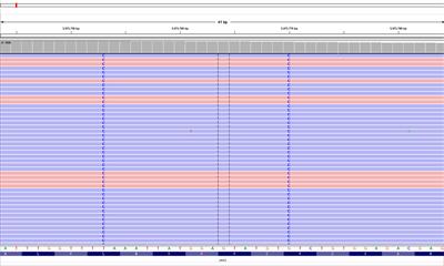 Case report: Double L611S/V617L JAK2 mutation in a patient with polycythemia vera originally diagnosed with essential thrombocythemia
